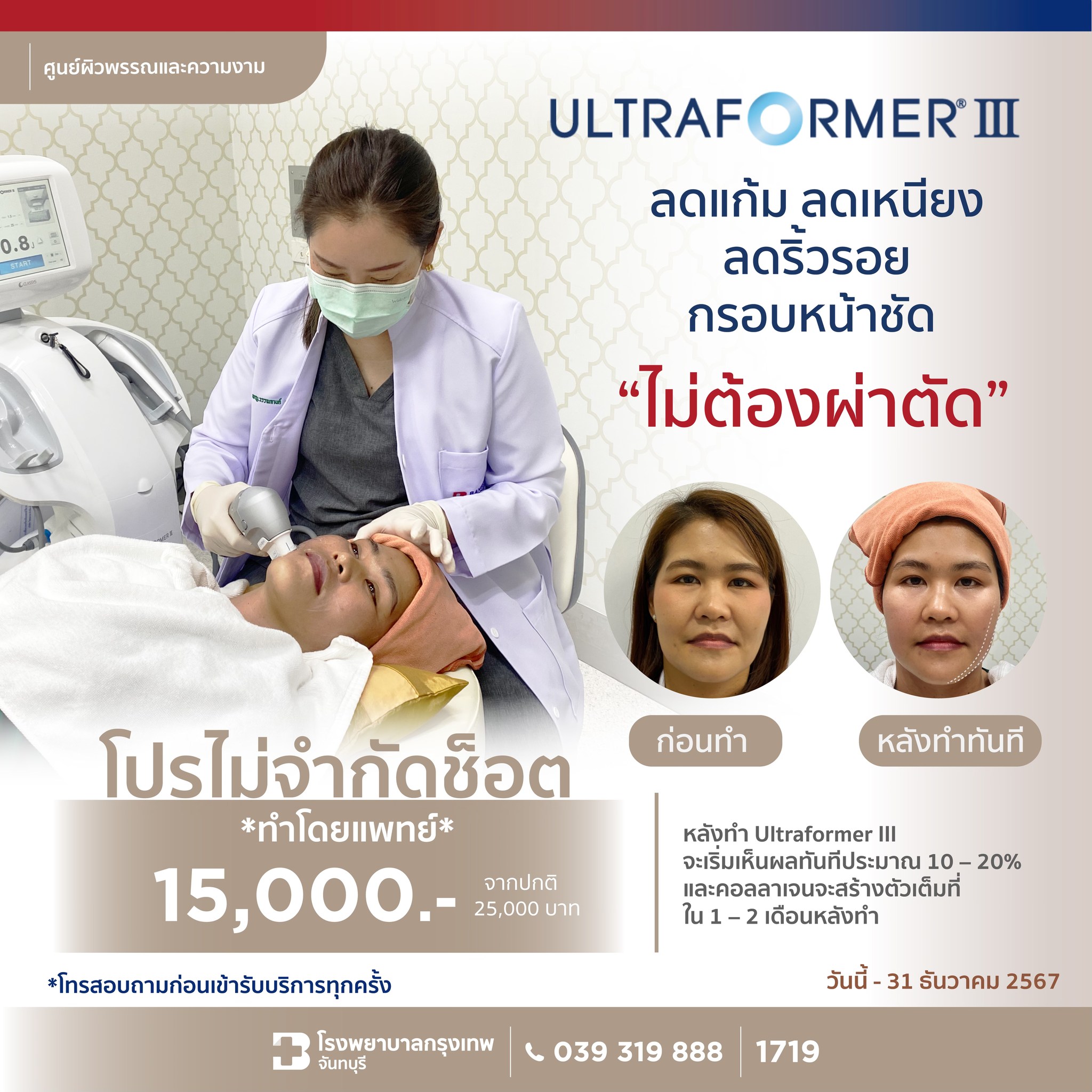 Ultraformer III ไม่จำกัดช็อต