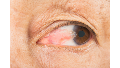 ต้อเนื้อ (pterygium)