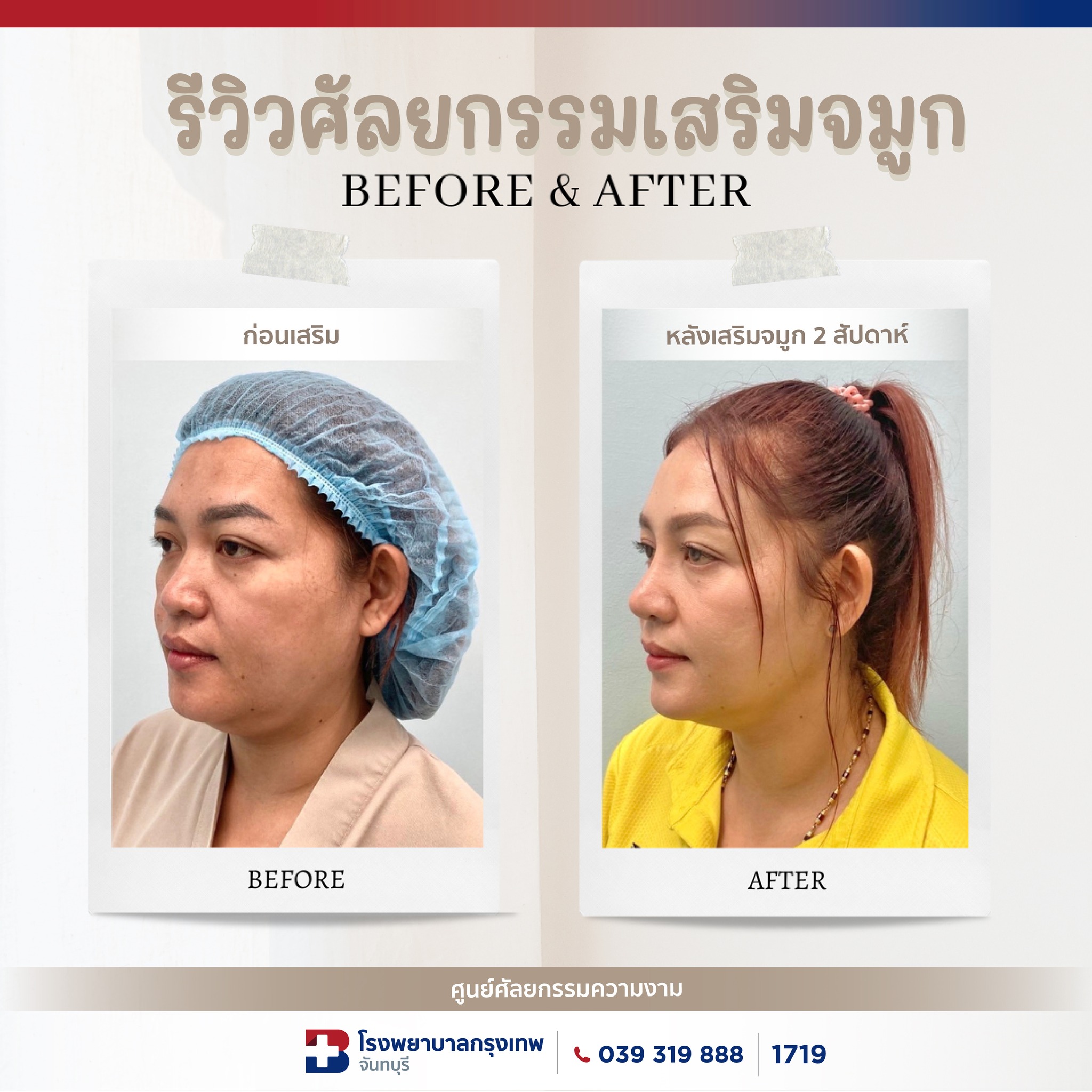 รีวิวศัลยกรรมเสริมจมูก