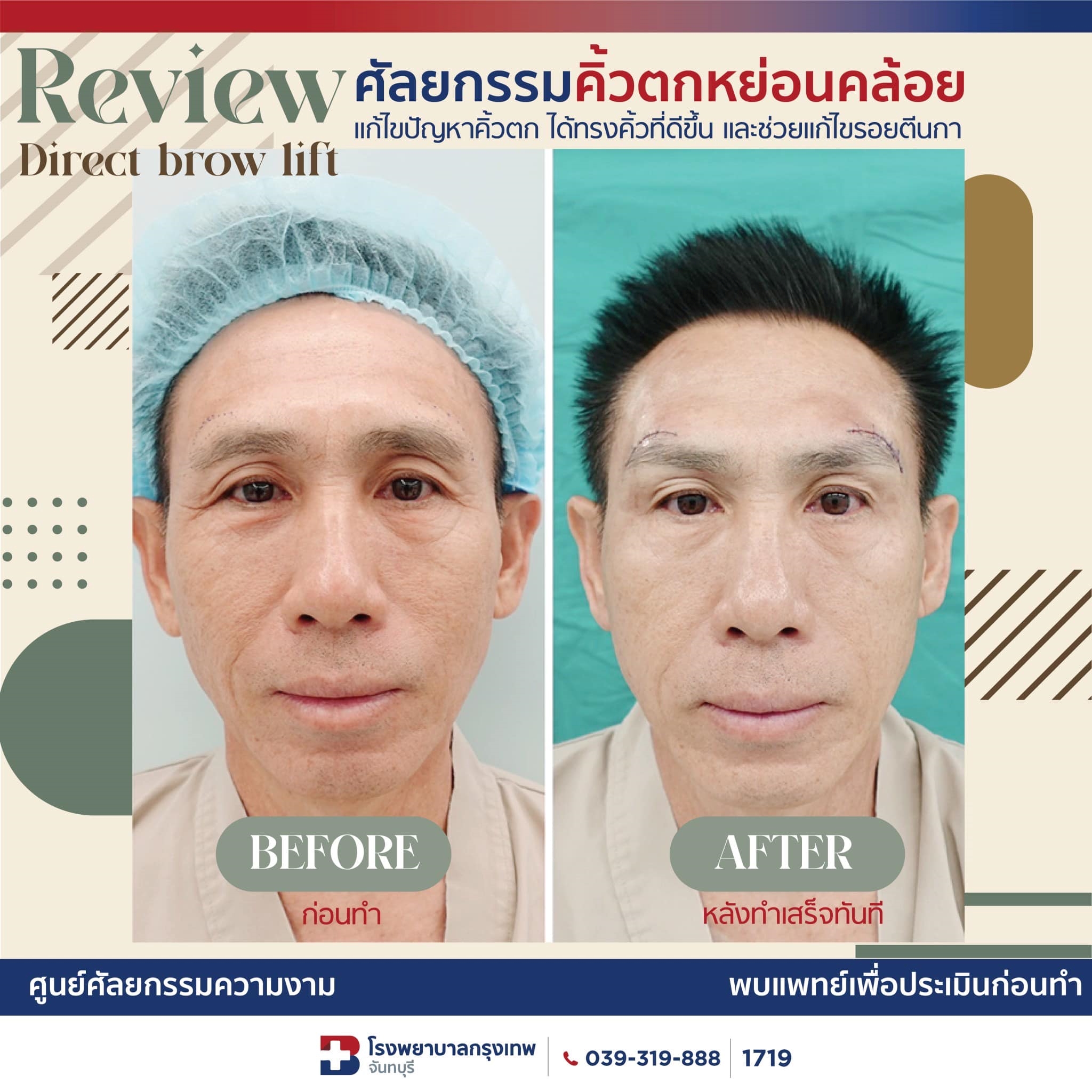 รีวิวศัลยกรรมแก้คิ้วตก