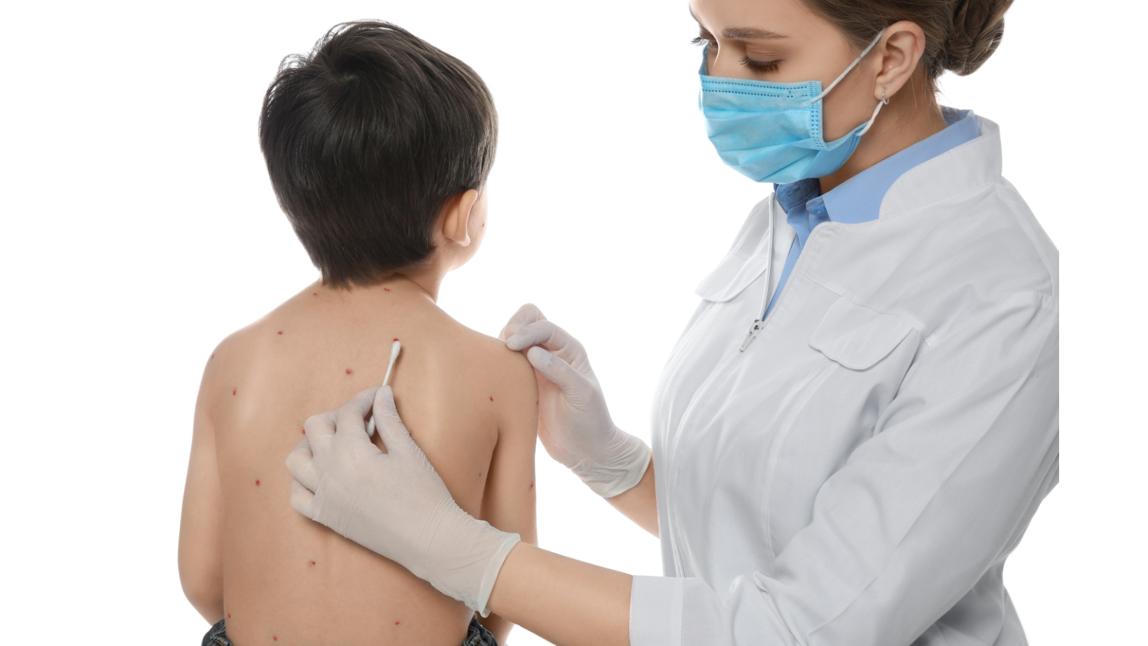 โรคอีสุกอีใส (Chickenpox/Varicella)