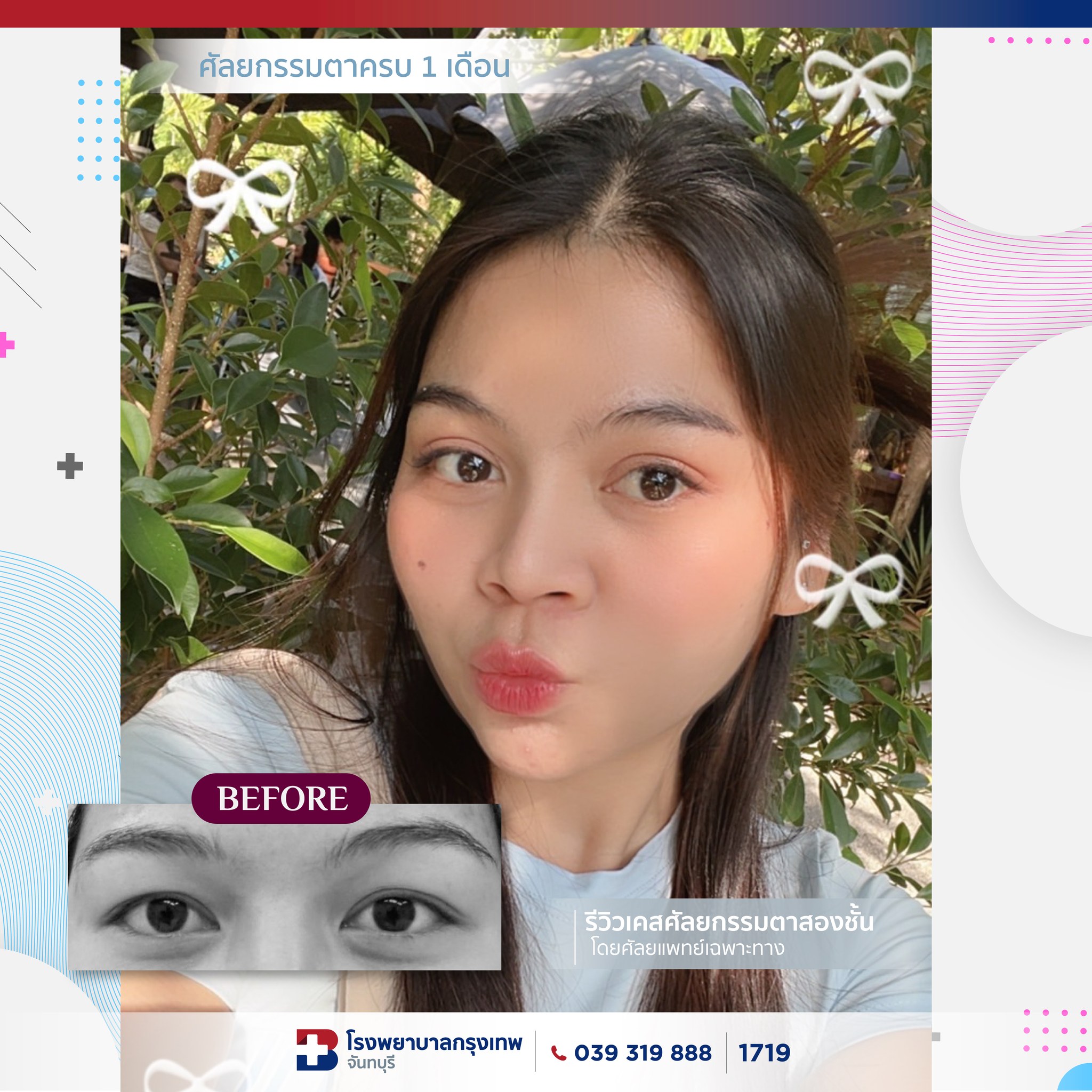 รีวิวศัลยกรรมตาสองชั้นครบ 1 เดือน