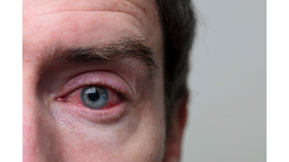 ม่านตาอักเสบ (Iritis / Anterior uveitis)