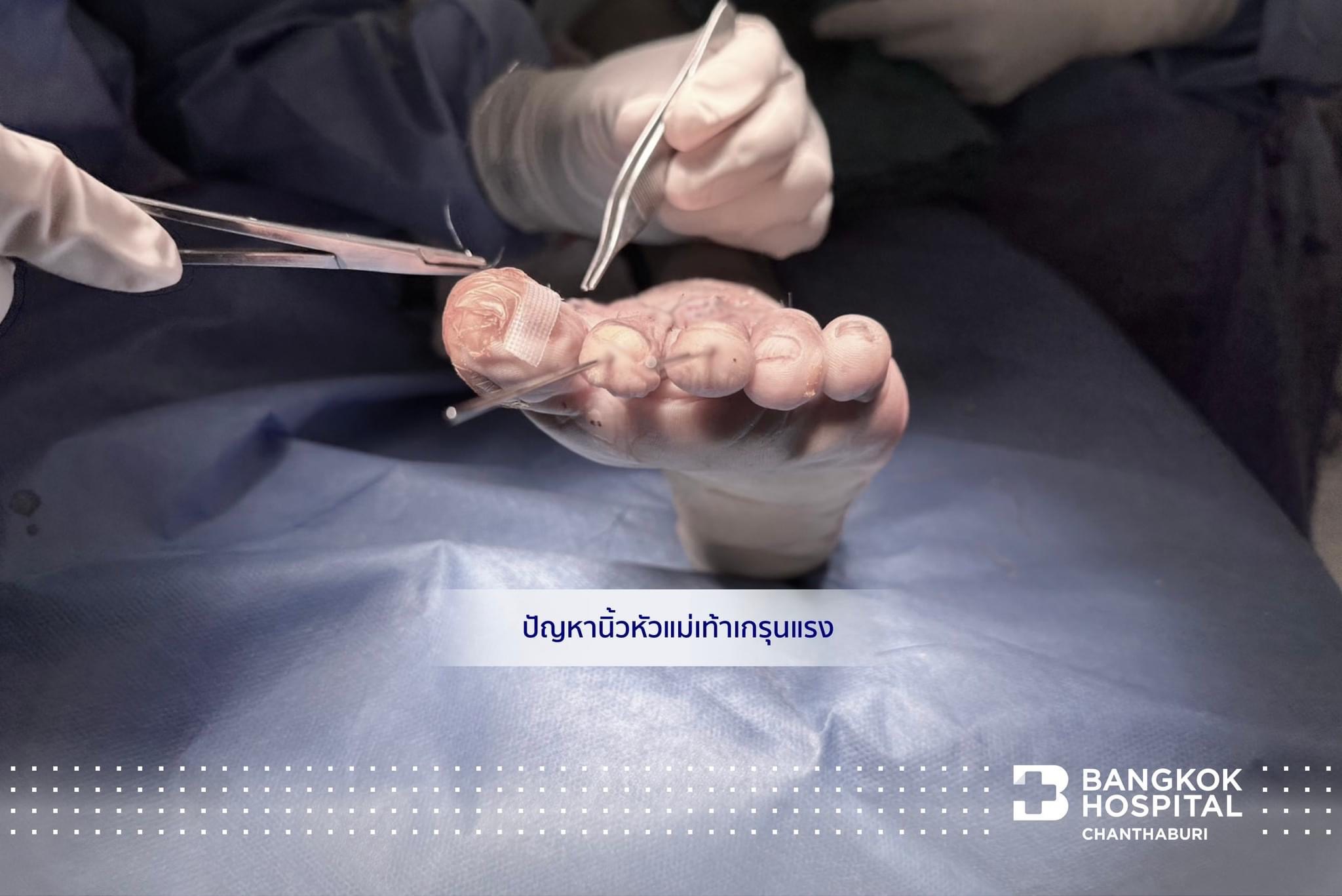 การผ่าตัดรักษานิ้วหัวแม่เท้าเกรุนแรง (Hallux Valg)
