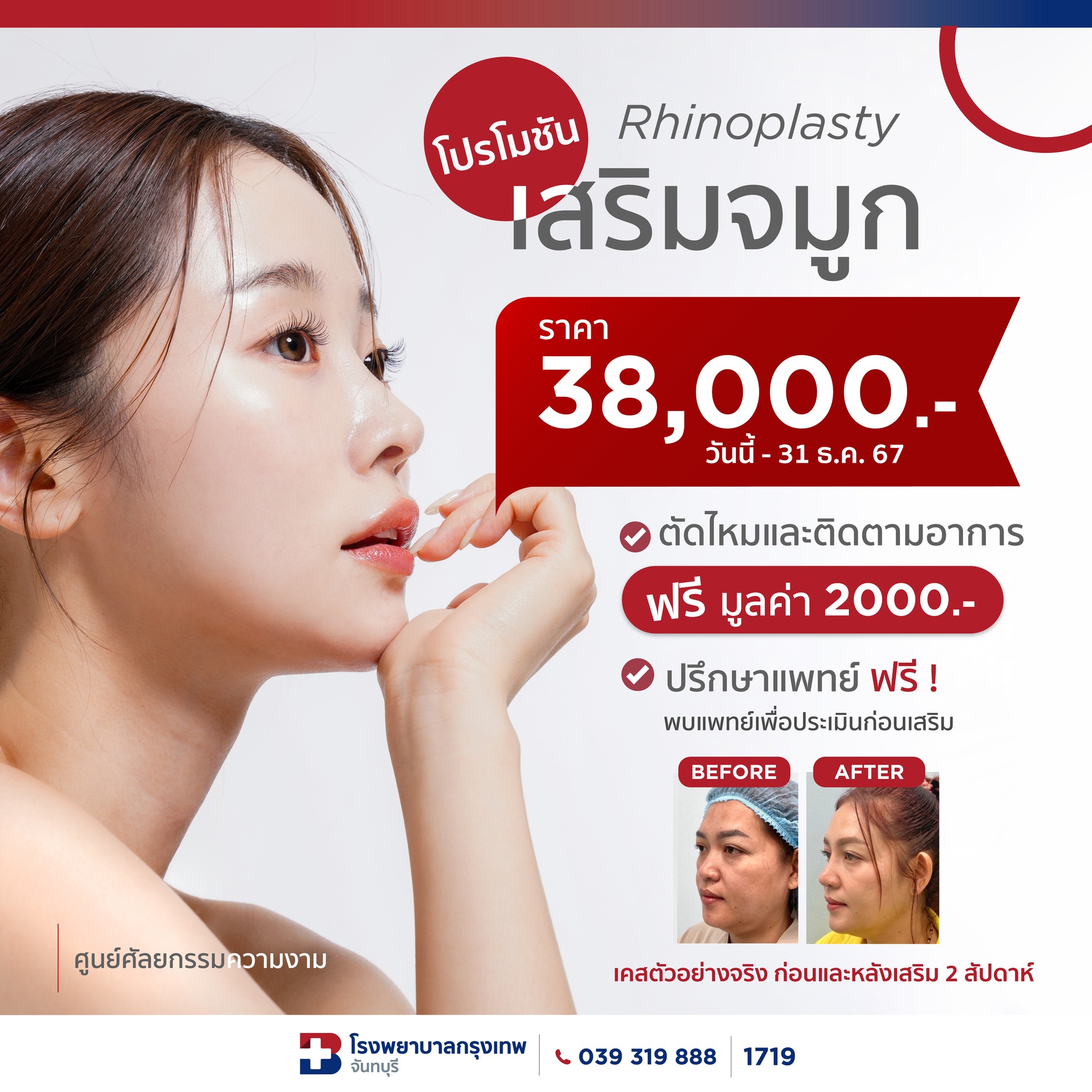 โปรโมชันเสริมจมูก