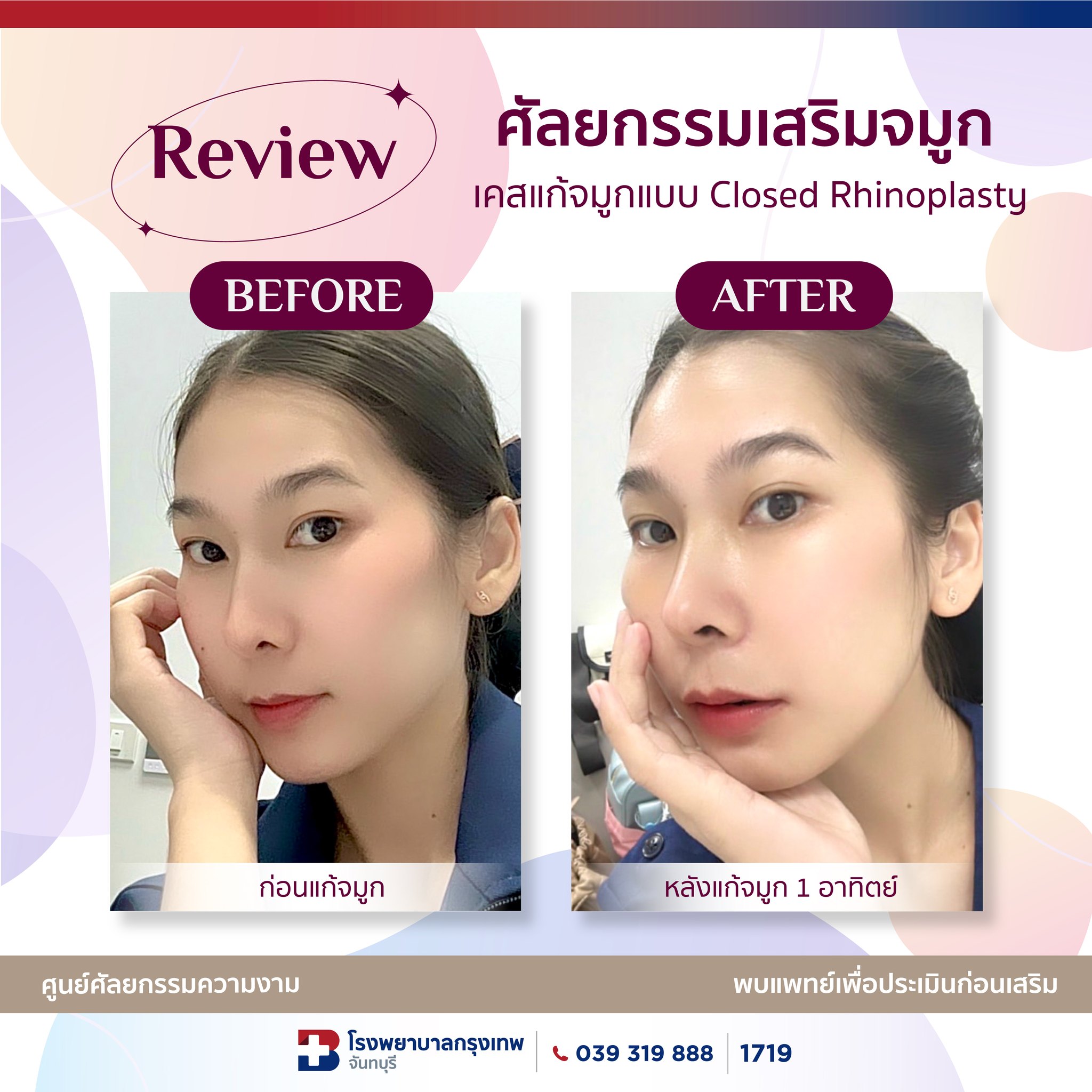 รีวิวหลังแก้จมูก 1 สัปดาห์